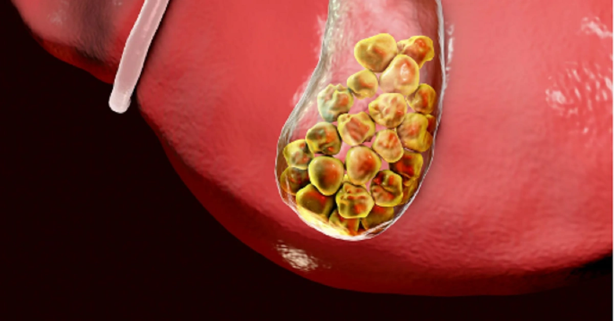 Cholerhiasis: Here we tell you about gallstones